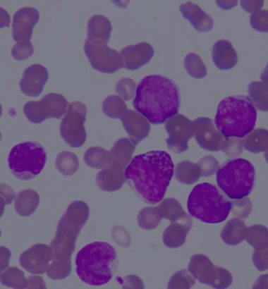 Breast Cancer HER2 Subtype Identification